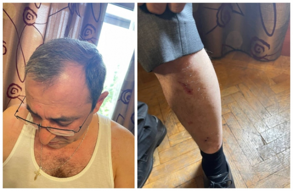 В ходе потасовки в НС Арцвик Минасян получил телесные повреждения (фото)